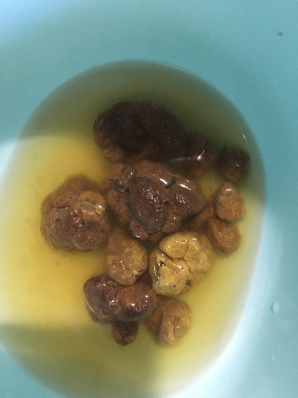 小女孩7岁,去年做了结肠息肉手术,之后就一直