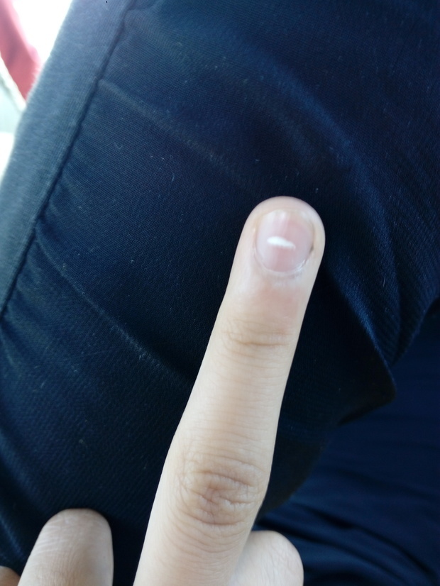 我的左手中指指甲盖上出现了白色的东西,是什