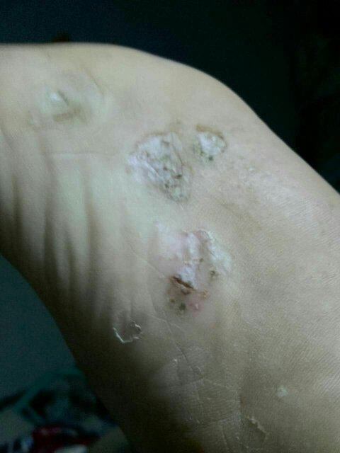 爸爸一直有脚气这次比较严重脚底都烂了裂开了