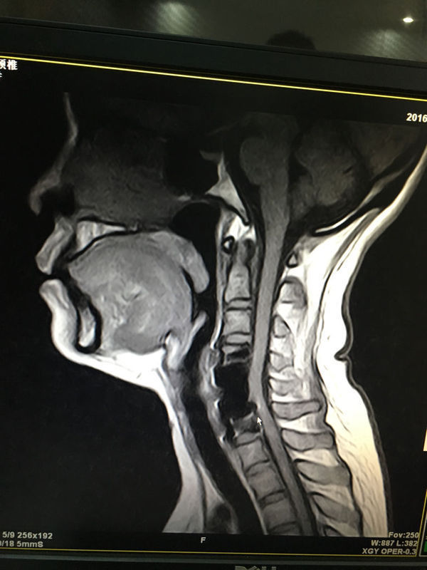 颈椎病做过手术安了泰龙,左边臀部一直感觉骨