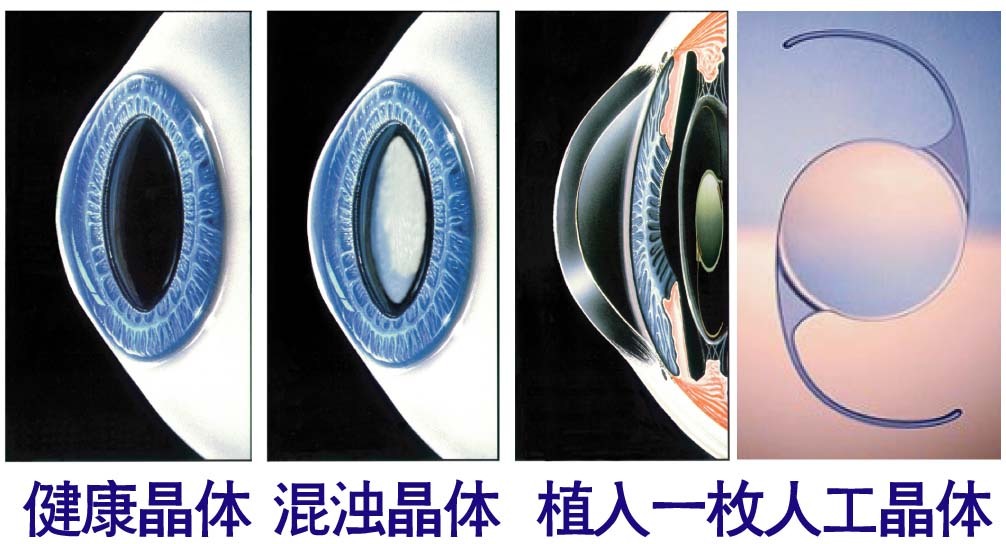 晶状体